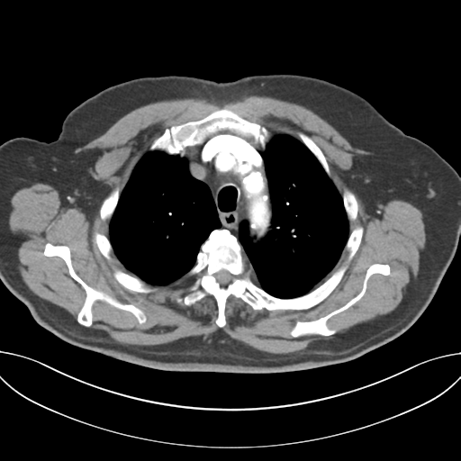 Adenocarcioma of rectum- T1 lesion (Radiopaedia 36921-38547 Axial C+ arterial phase 16).png