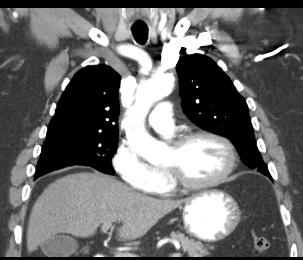 Adenocarcioma of rectum- T1 lesion (Radiopaedia 36921-38547 Coronal C+ arterial phase 27).png