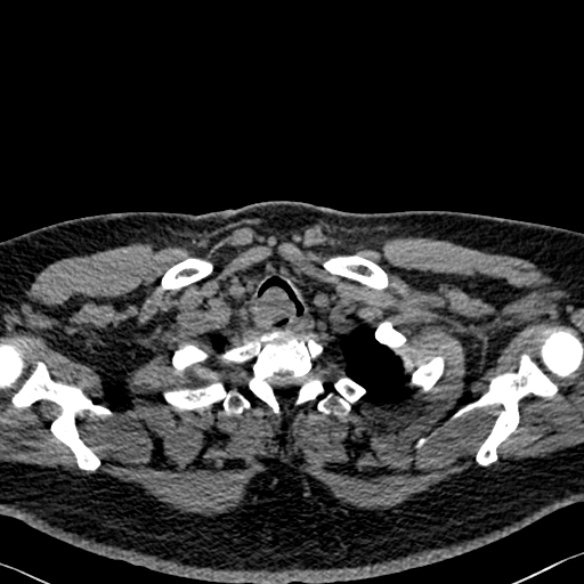 File:Adenoid cystic carcinoma of the trachea (Radiopaedia 49042-54137 Axial non-contrast 22).jpg