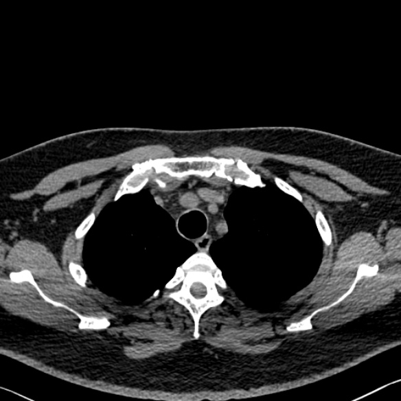 File:Adenoid cystic carcinoma of the trachea (Radiopaedia 49042-54137 Axial non-contrast 65).jpg