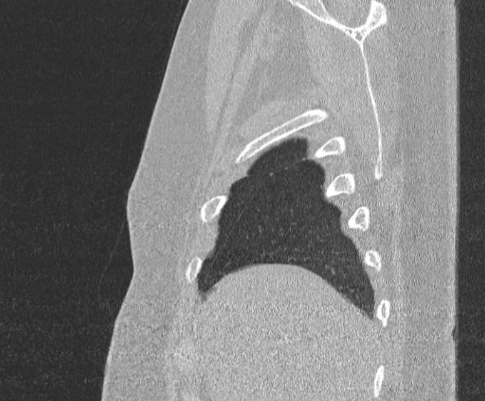 File:Adenoid cystic carcinoma of the trachea (Radiopaedia 49042-54137 Sagittal lung window 58).jpg
