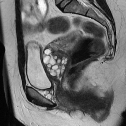 File:Adenoma malignum of cervix (Radiopaedia 66441-75705 Sagittal T2 13).jpg