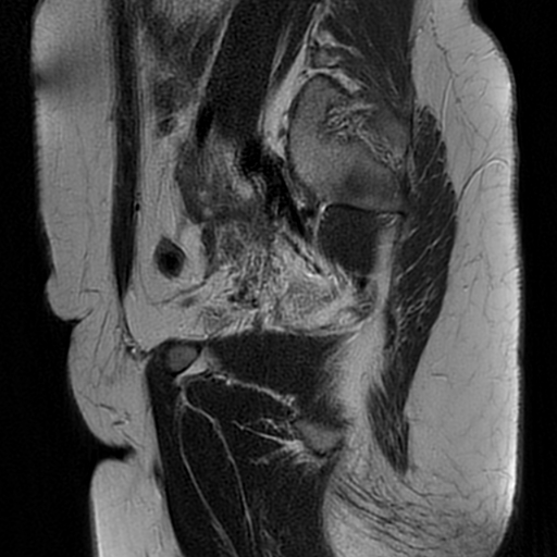 File:Adenomyosis-scar endometriosis (Radiopaedia 65863-75022 Sagittal T2 22).jpg