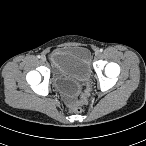 Adhesional small bowel obstruction (Radiopaedia 52107-57980 Axial C+ portal venous phase 117).jpg