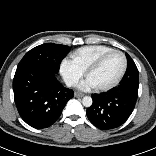File:Adhesional small bowel obstruction (Radiopaedia 58900-66131 Axial C+ portal venous phase 2).jpg