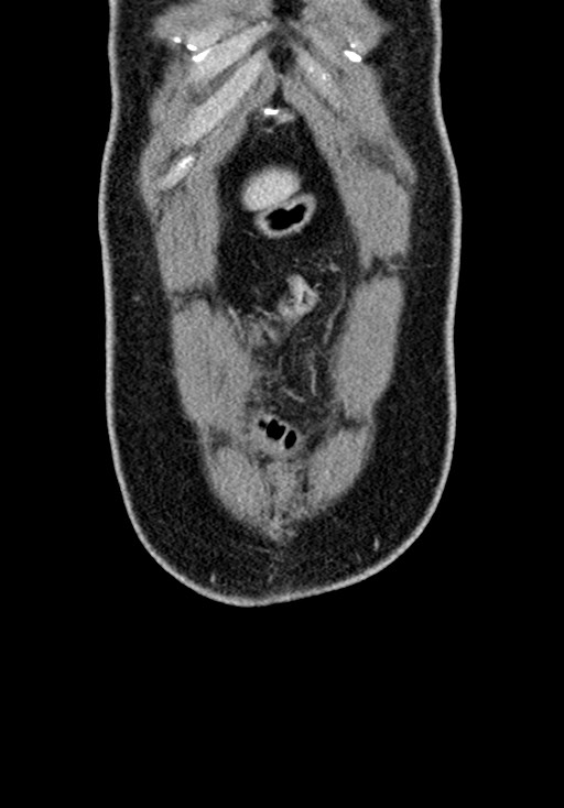 Adhesional small bowel obstruction (Radiopaedia 58900-66131 Coronal C+ portal venous phase 61).jpg