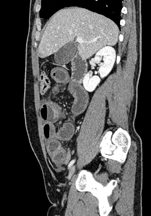 Adhesional small bowel obstruction (Radiopaedia 58900-66131 Sagittal C+ portal venous phase 84).jpg
