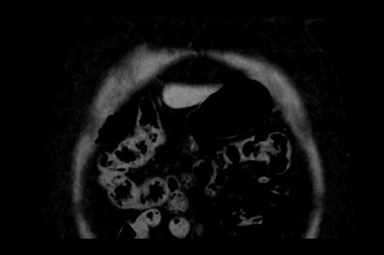File:Adrenal cortical carcinoma (Radiopaedia 64017-72769 Coronal non-contrast 9).jpg