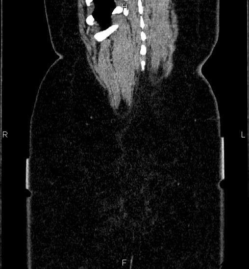 Adrenal cortical carcinoma (Radiopaedia 84882-100379 Coronal C+ portal venous phase 64).jpg