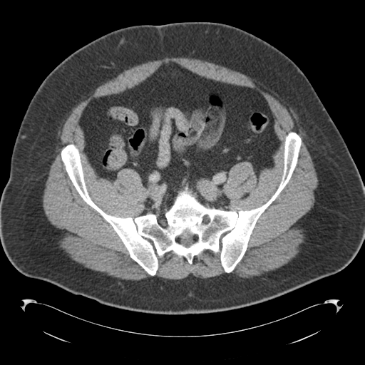 Adrenal cyst (Radiopaedia 45625-49776 Axial C+ portal venous phase 73).png