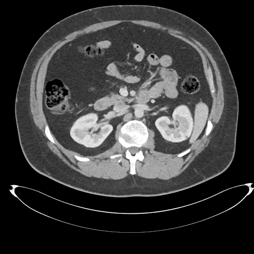 File:Adrenal cyst (Radiopaedia 45625-49778 AXIAL THICK 60 sec 33).png