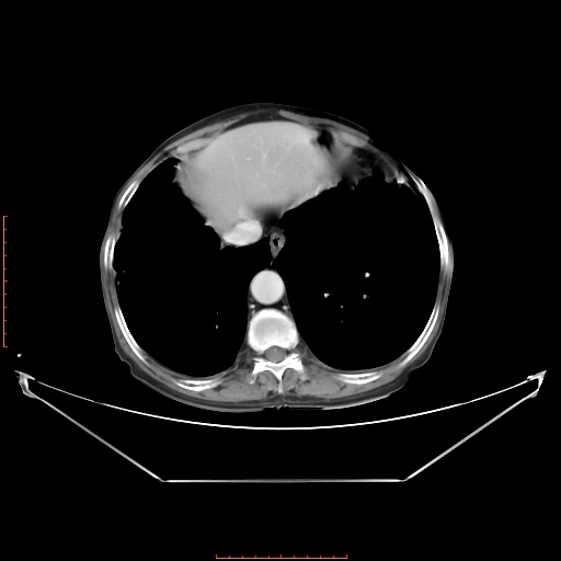 Adrenal hemangioma (Radiopaedia 68923-78668 Axial C+ portal venous phase 14).jpg