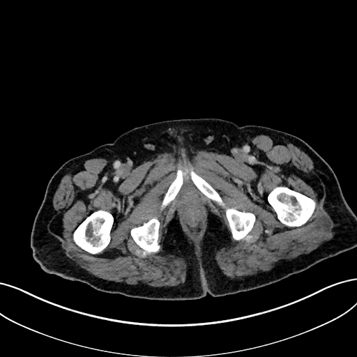 Adrenal lymphoma (Radiopaedia 73730-84529 Axial C+ portal venous phase 135).jpg