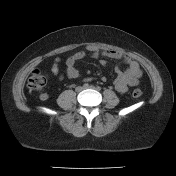 Adrenal myelolipoma (Radiopaedia 43401-46759 Axial non-contrast 54).jpg