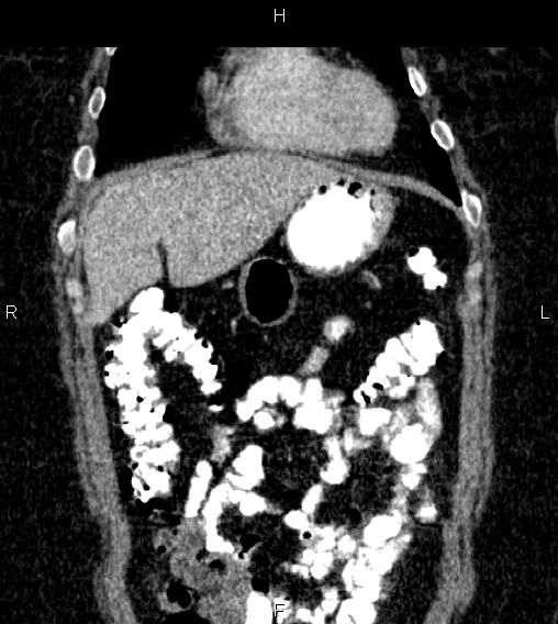 Adrenal myelolipoma (Radiopaedia 84319-99617 Coronal renal cortical phase 16).jpg