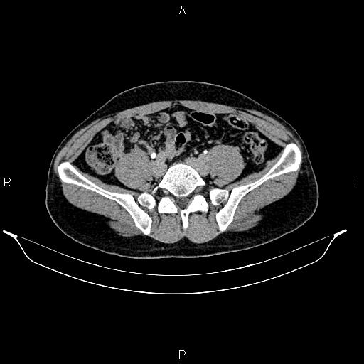 Adrenal myelolipoma (Radiopaedia 87794-104246 Axial renal excretory phase 72).jpg