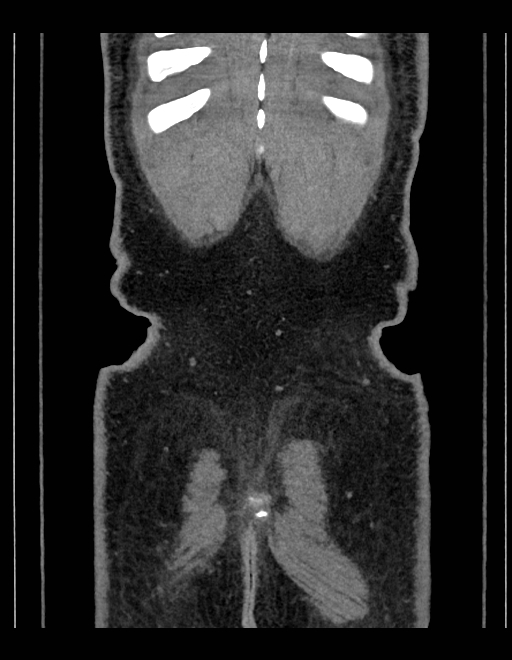 Adrenal myelolipoma - bilateral (Radiopaedia 74805-85810 Coronal C+ portal venous phase 46).jpg