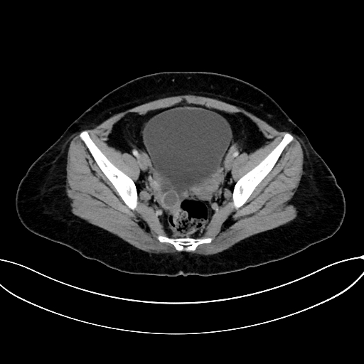 Adrenocortical carcinoma (Radiopaedia 87281-103569 Axial C+ portal venous phase 73).jpg