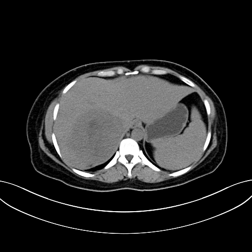 Adrenocortical carcinoma (Radiopaedia 87281-103569 Axial non-contrast 17).jpg