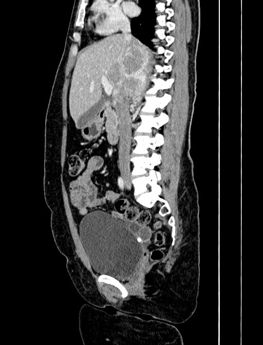Adrenocortical carcinoma (Radiopaedia 87281-103569 Sagittal C+ portal venous phase 127).jpg