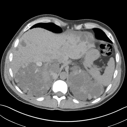 File:Adult polycystic kidney disease (Radiopaedia 47866-52626 Axial non-contrast 13).png