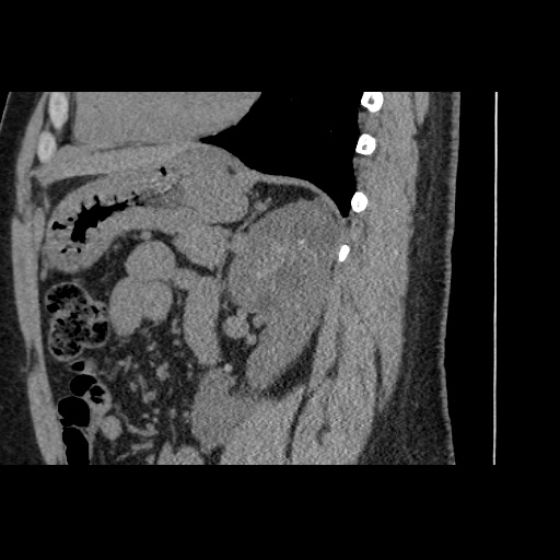 Adult polycystic kidney disease (Radiopaedia 59075-66368 Sagittal non-contrast 58).jpg