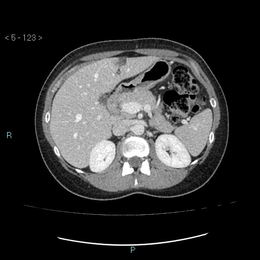 Adult transient intestinal intussusception (Radiopaedia 34853-36310 Axial C+ portal venous phase 10).jpg