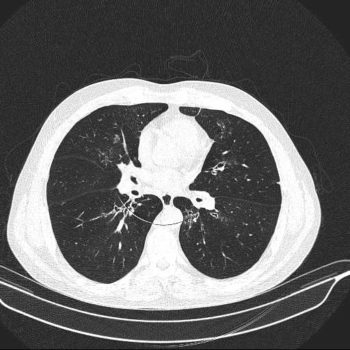 File:Allergic bronchopulmonary aspergillosis (Radiopaedia 21386-21320 Axial lung window 20).jpg