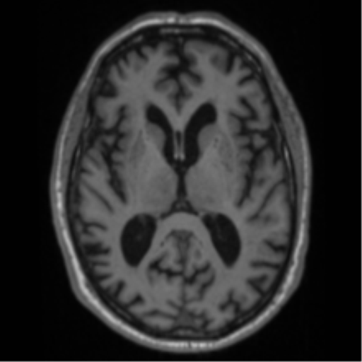 File:Alzheimer's disease- with Gerstmann syndrome and dressing apraxia (Radiopaedia 54882-61150 Axial T1 39).png
