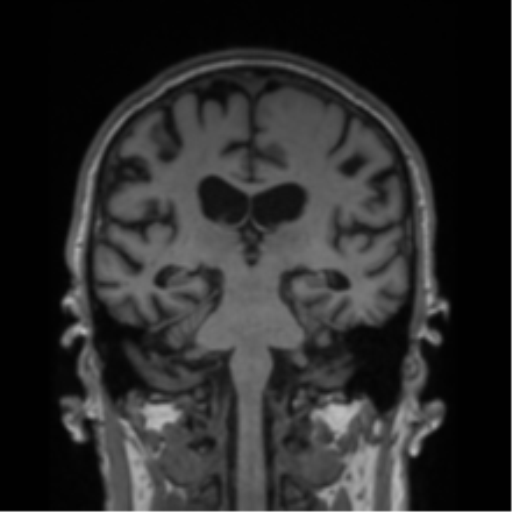 Alzheimer's disease- with Gerstmann syndrome and dressing apraxia (Radiopaedia 54882-61150 Coronal T1 39).png