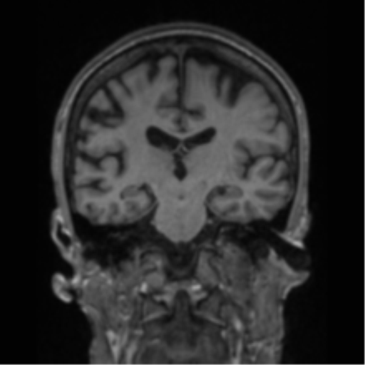 File:Alzheimer's disease- with apraxia (Radiopaedia 54763-61011 Coronal T1 46).png