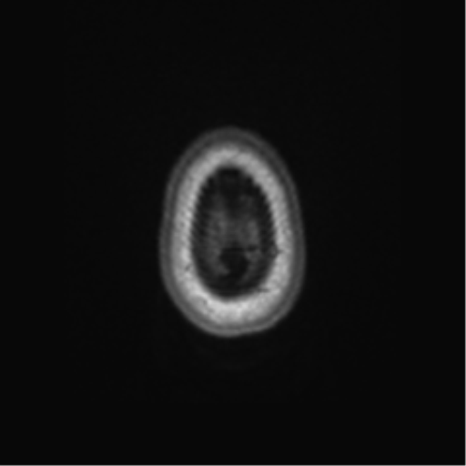 File:Alzheimer's disease (Radiopaedia 42658-45802 Axial T1 11).png
