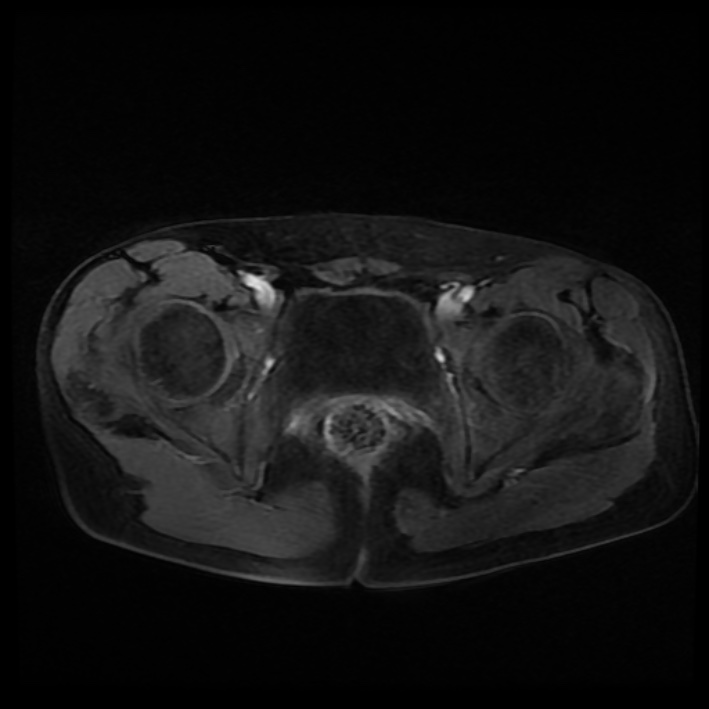 Ambiguous genitalia (Radiopaedia 69686-79643 Axial T1 C+ fat sat 35).jpg