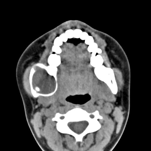 File:Ameloblastoma (Radiopaedia 26645-26793 Axial C+ delayed 18).jpg