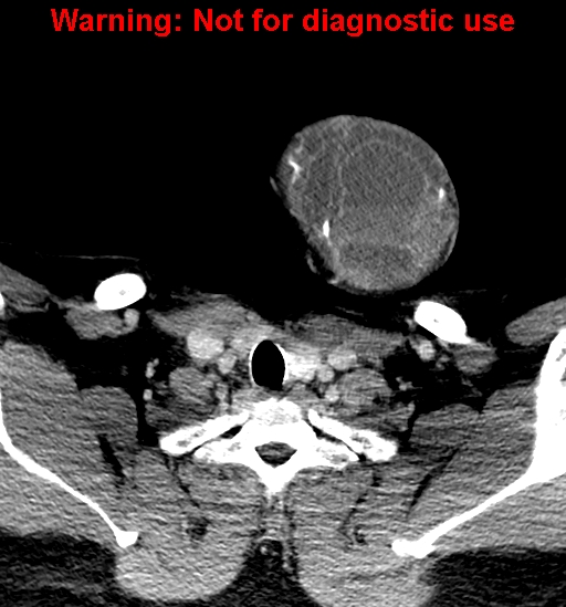 File:Ameloblastoma (Radiopaedia 33126-34164 B 38).jpg