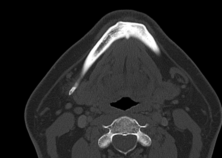 Ameloblastoma (Radiopaedia 38520-40623 D 38).png