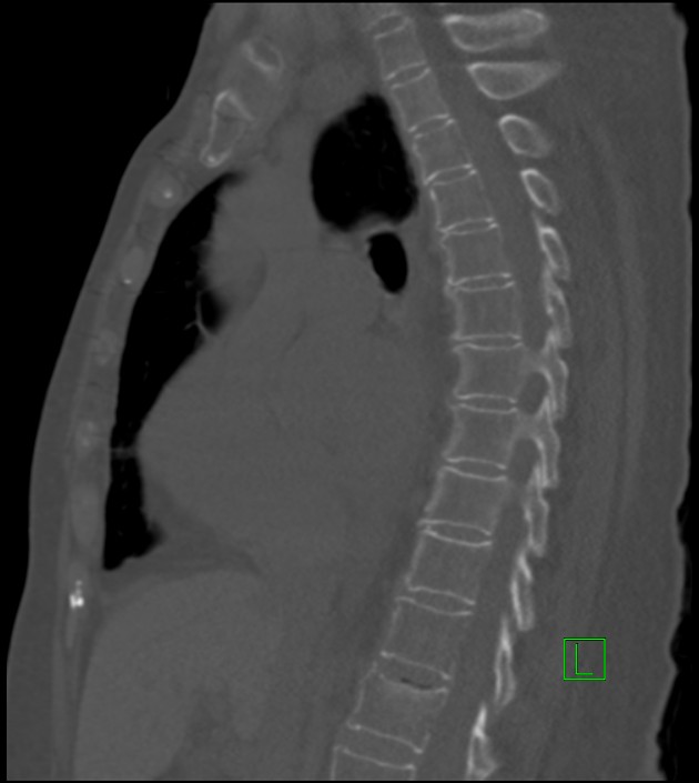 Amiodarone deposition in the liver (Radiopaedia 77587-89780 Sagittal bone window 53).jpg