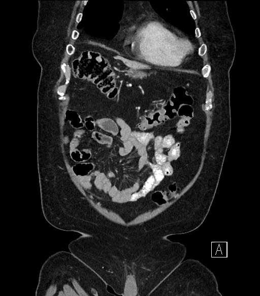 Ampullary adenocarcinoma (Radiopaedia 59373-66734 D 12).jpg