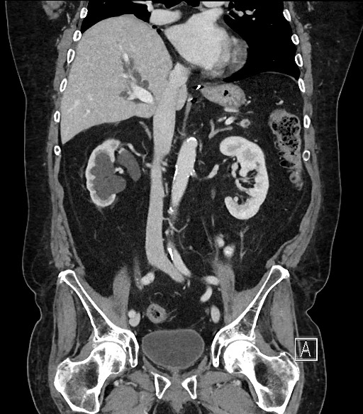 Ampullary adenocarcinoma (Radiopaedia 59373-66734 D 57).jpg