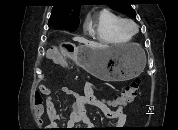 Ampullary adenocarcinoma (Radiopaedia 59373-66737 B 21).jpg