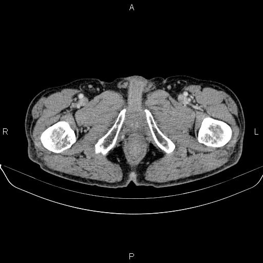 Ampullary adenocarcinoma (Radiopaedia 86093-102032 A 61).jpg