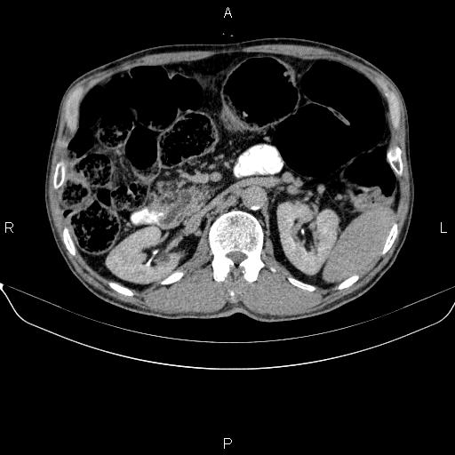 Ampullary adenocarcinoma (Radiopaedia 86093-102032 Axial C+ delayed 38).jpg