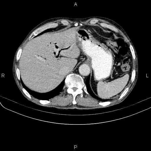 Ampullary adenocarcinoma (Radiopaedia 86093-102033 B 51).jpg