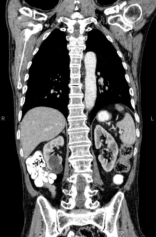 Ampullary adenocarcinoma (Radiopaedia 86093-102033 D 42).jpg