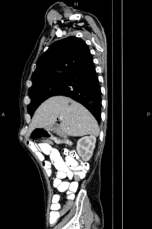 Ampullary adenocarcinoma (Radiopaedia 86093-102033 E 21).jpg