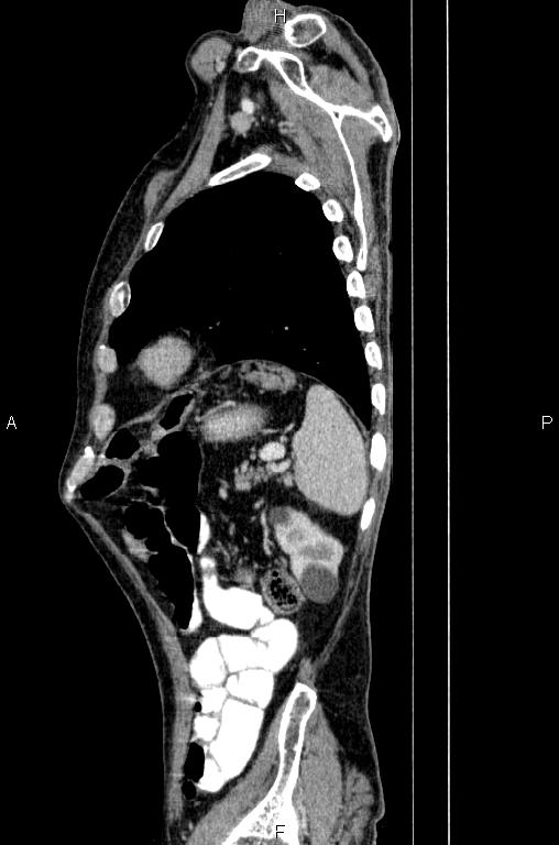 Ampullary adenocarcinoma (Radiopaedia 86093-102033 E 76).jpg
