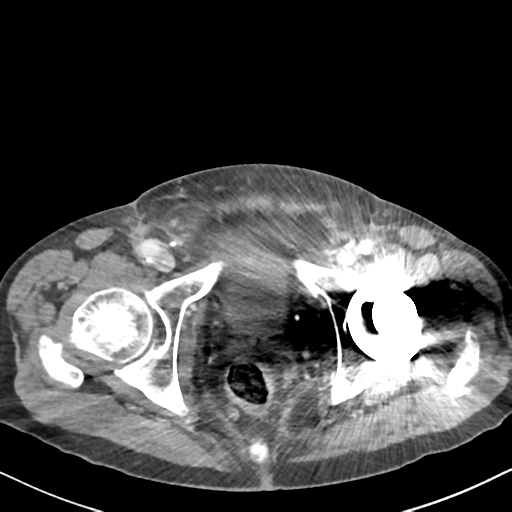 File:Amyand hernia (Radiopaedia 39300-41547 A 70).png