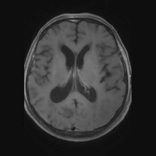 File:Amyloid angiopathy with inflammation (Radiopaedia 30360-31002 Axial T1 C+ fat sat 18).jpg