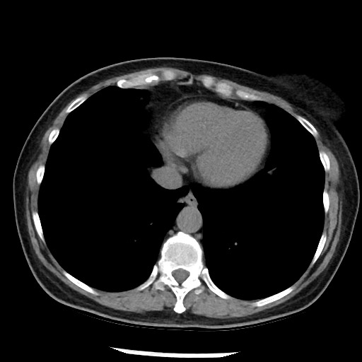 File:Amyloidosis - bronchial and diffuse nodular pulmonary involvement (Radiopaedia 60156-67744 Axial non-contrast 43).jpg
