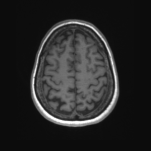 File:Anaplastic astrocytoma - thalamic glioma (Radiopaedia 59709-67115 Axial T1 34).png
